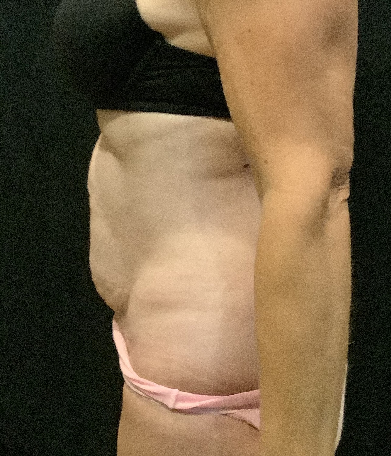 Tummy Tuck Before & After