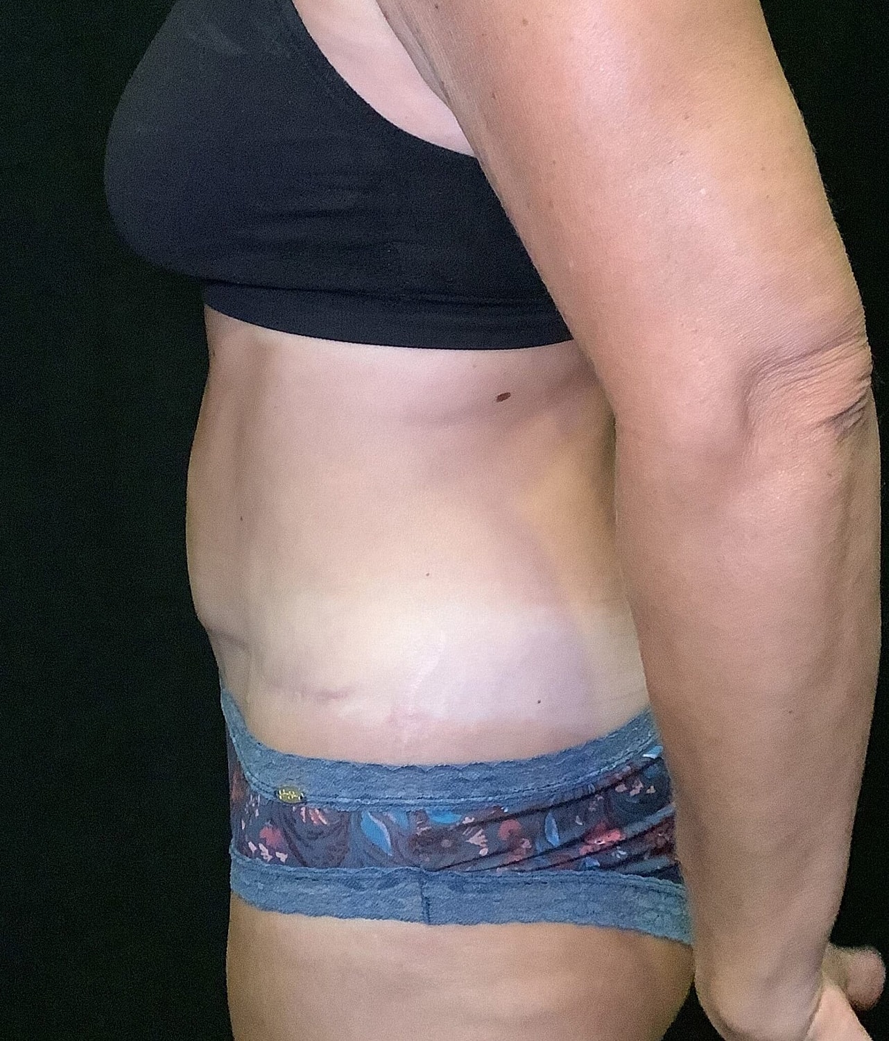 Tummy Tuck Before & After
