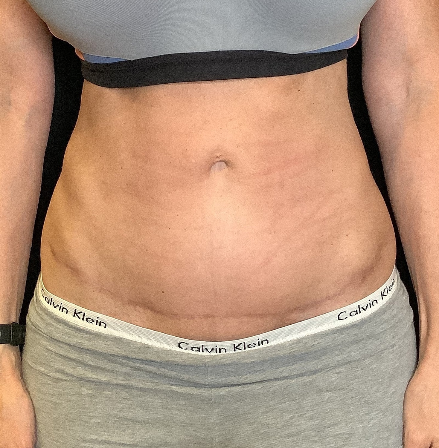 Tummy Tuck Before & After