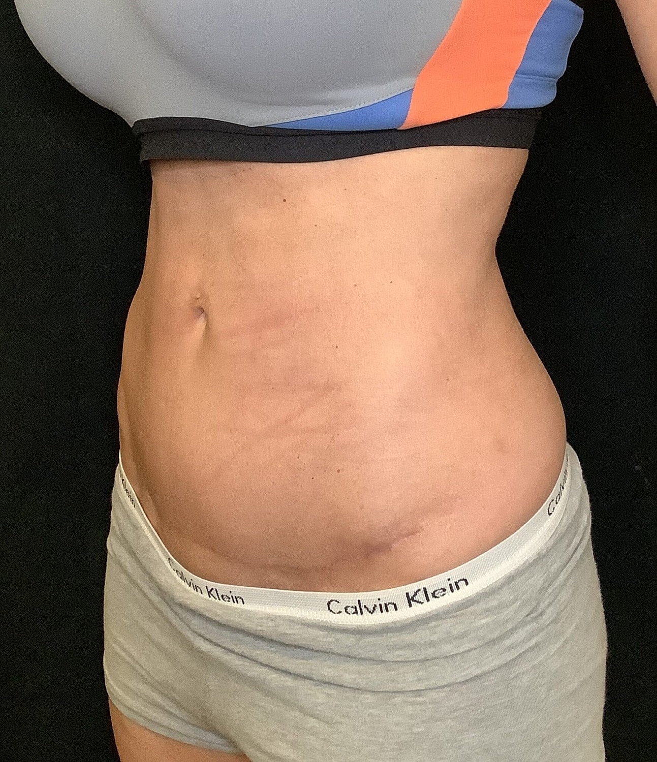 Tummy Tuck Before & After