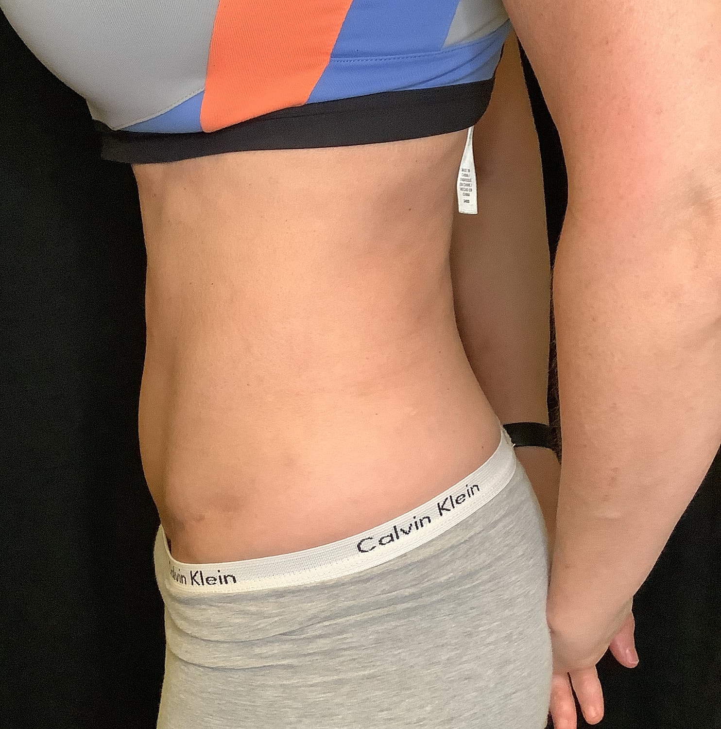 Tummy Tuck Before & After