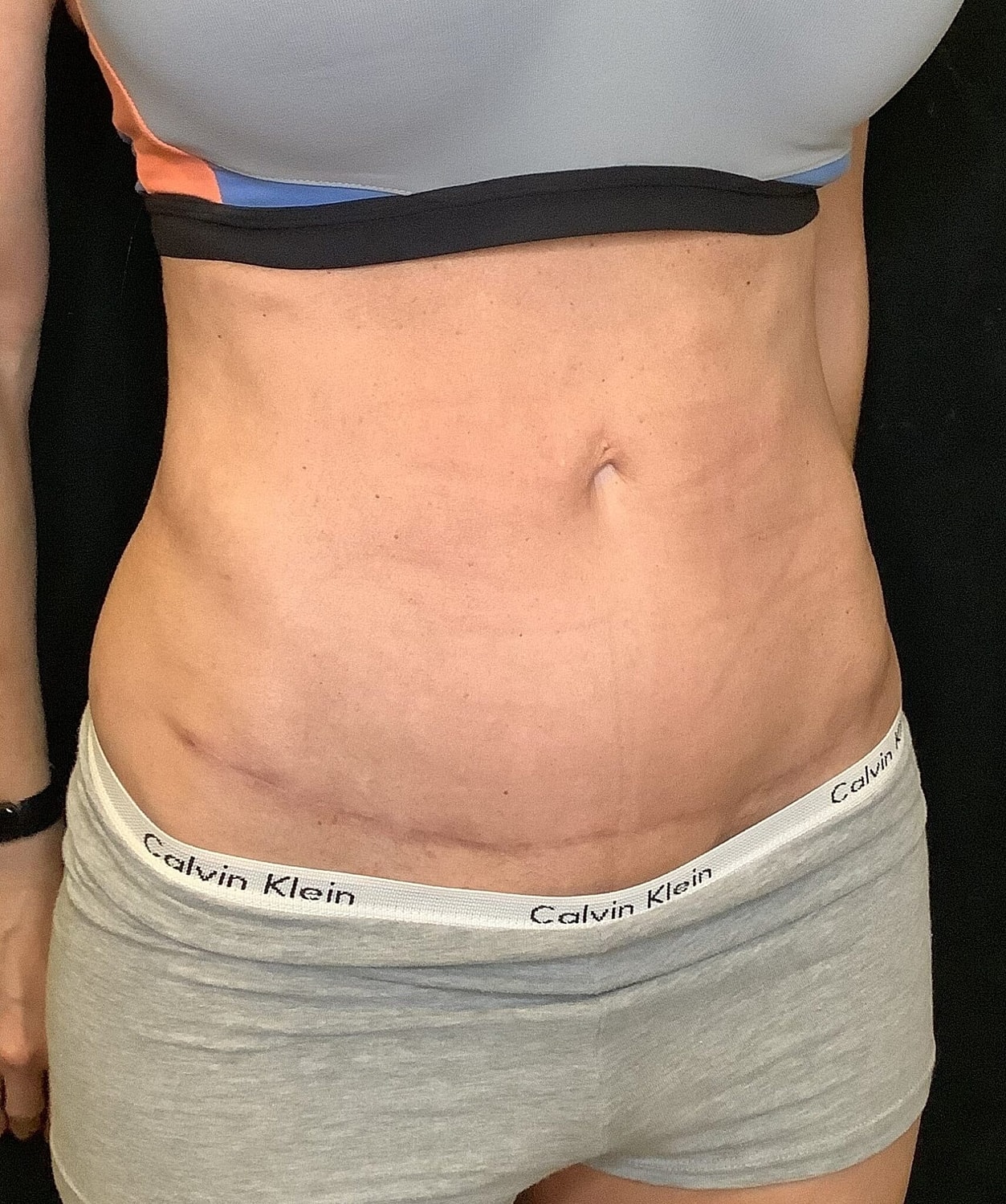 Tummy Tuck Before & After