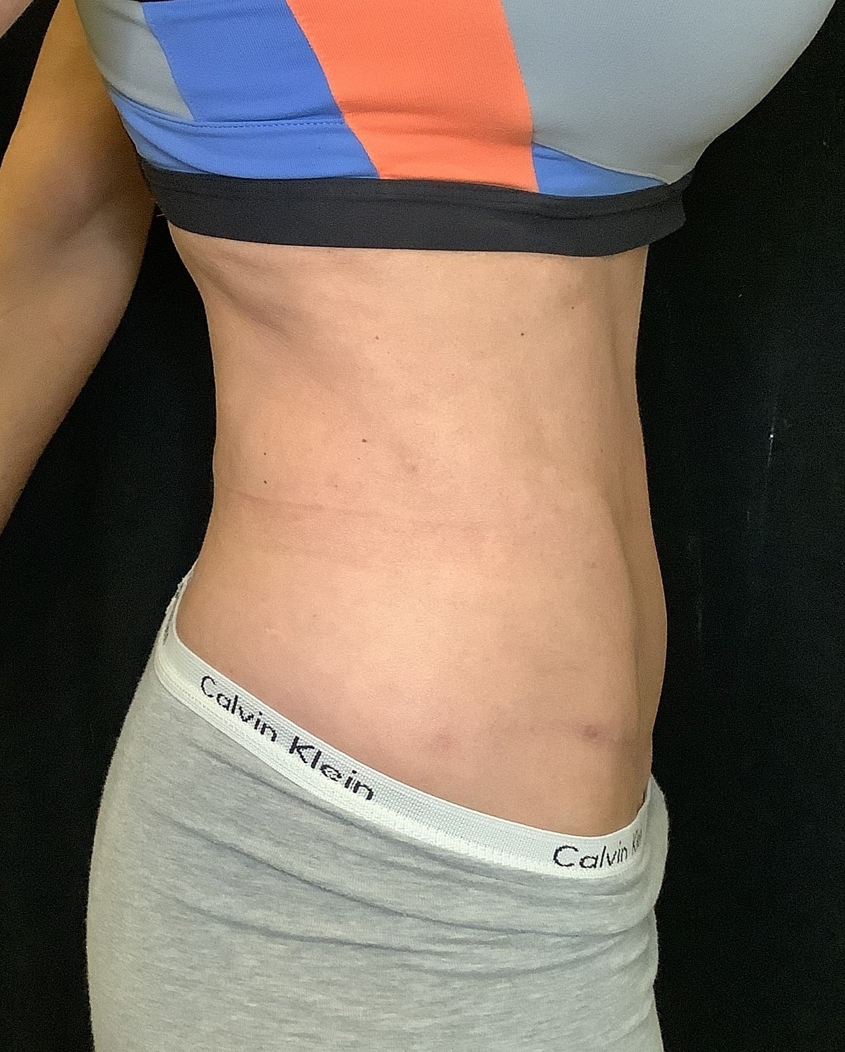Tummy Tuck Before & After