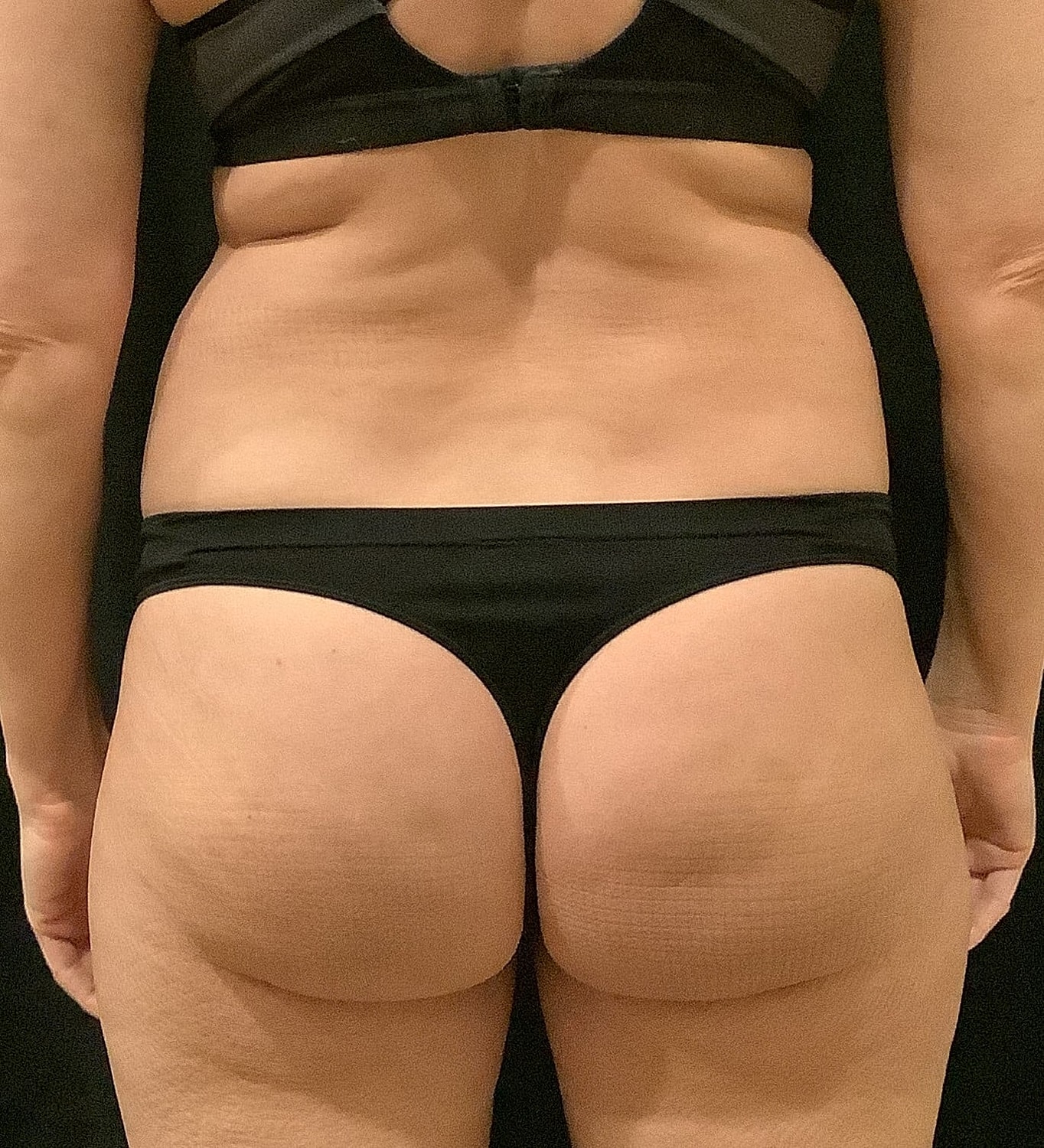 Tummy Tuck Before & After