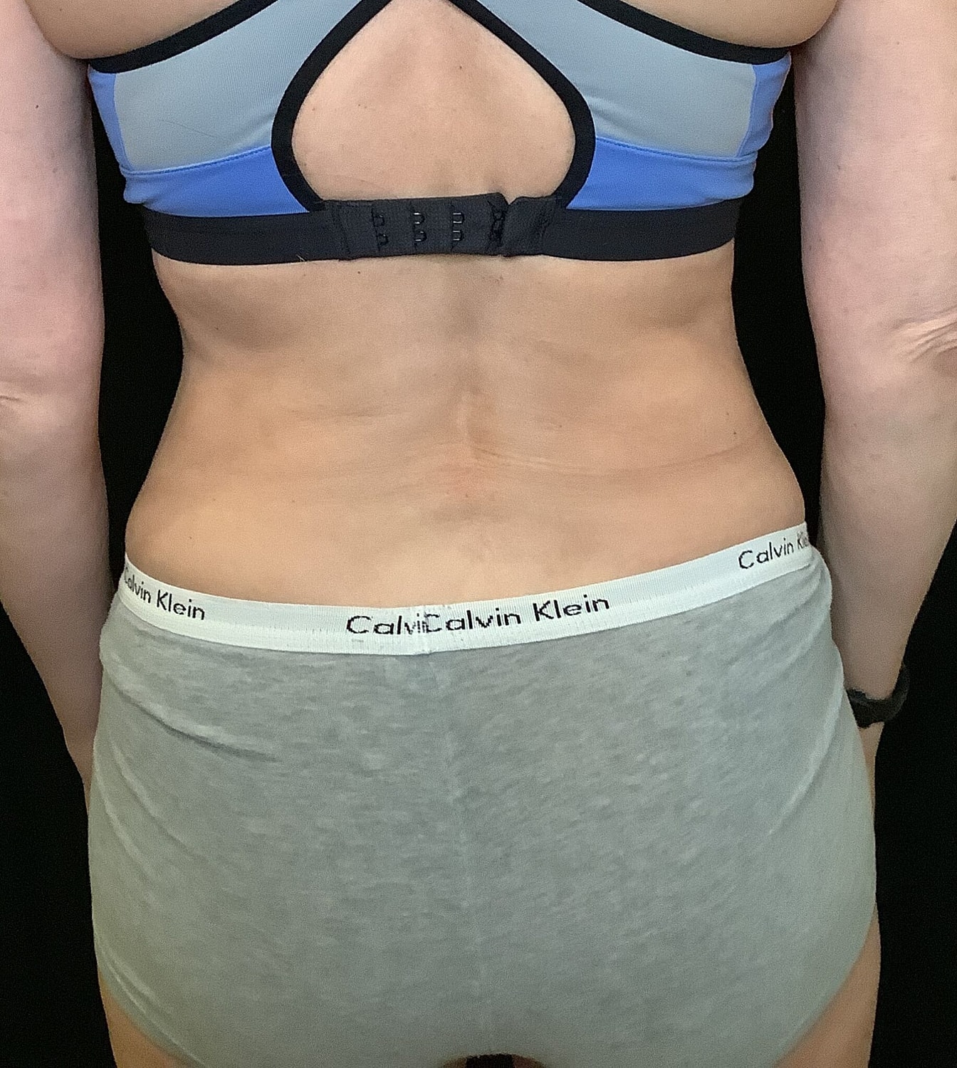 Tummy Tuck Before & After