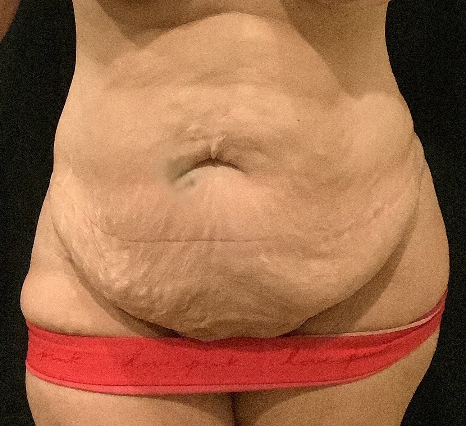 Tummy Tuck Before & After