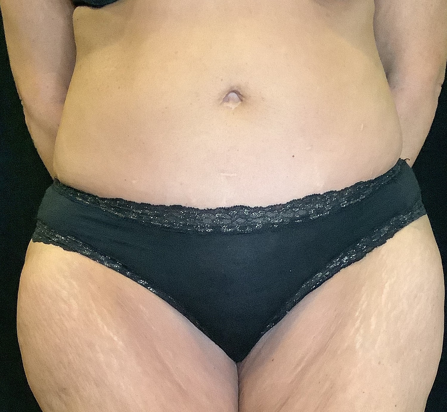 Tummy Tuck Before & After