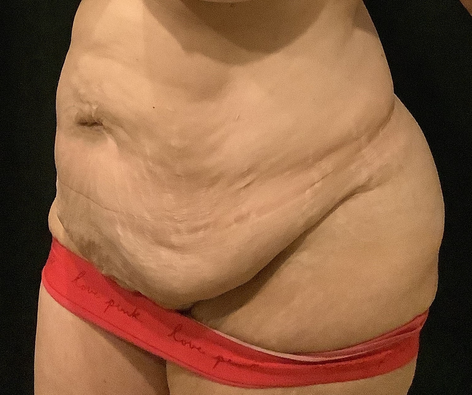Tummy Tuck Before & After