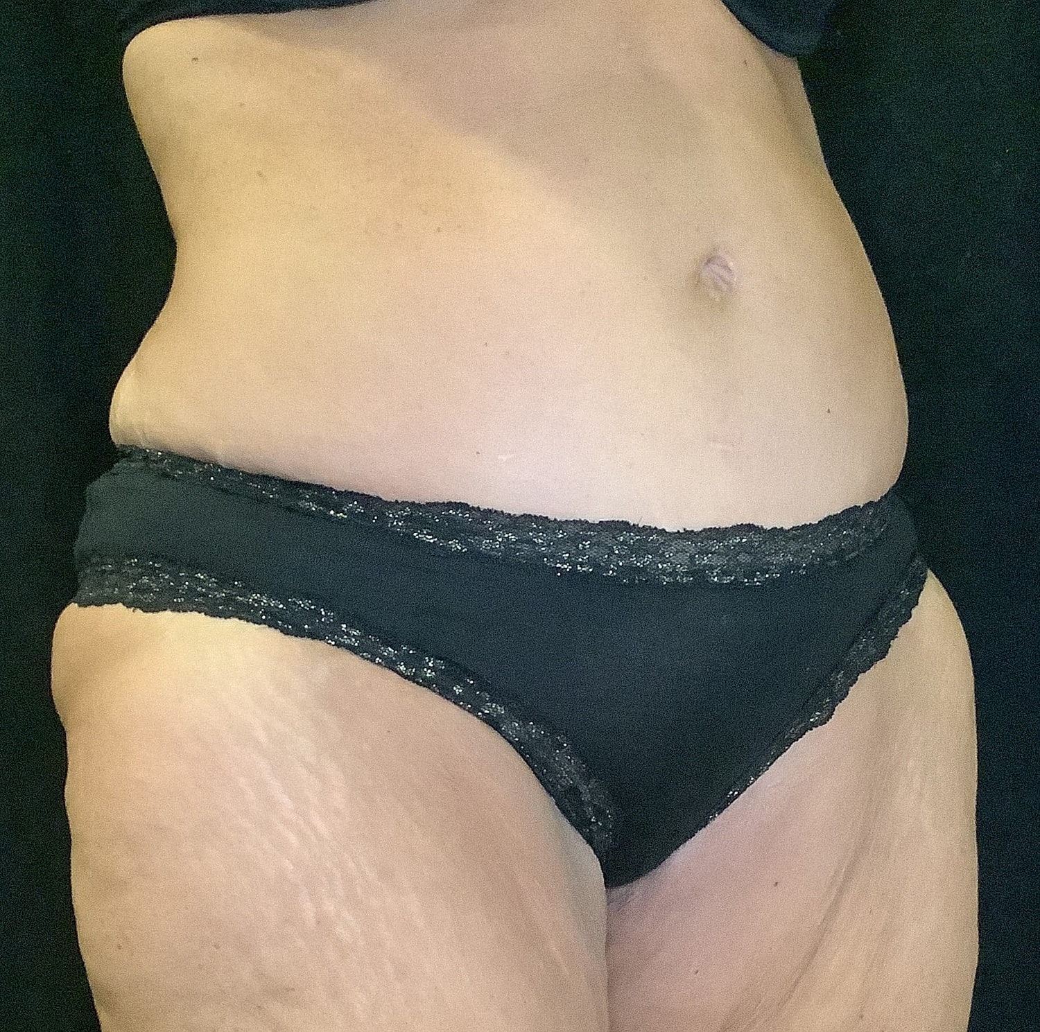 Tummy Tuck Before & After