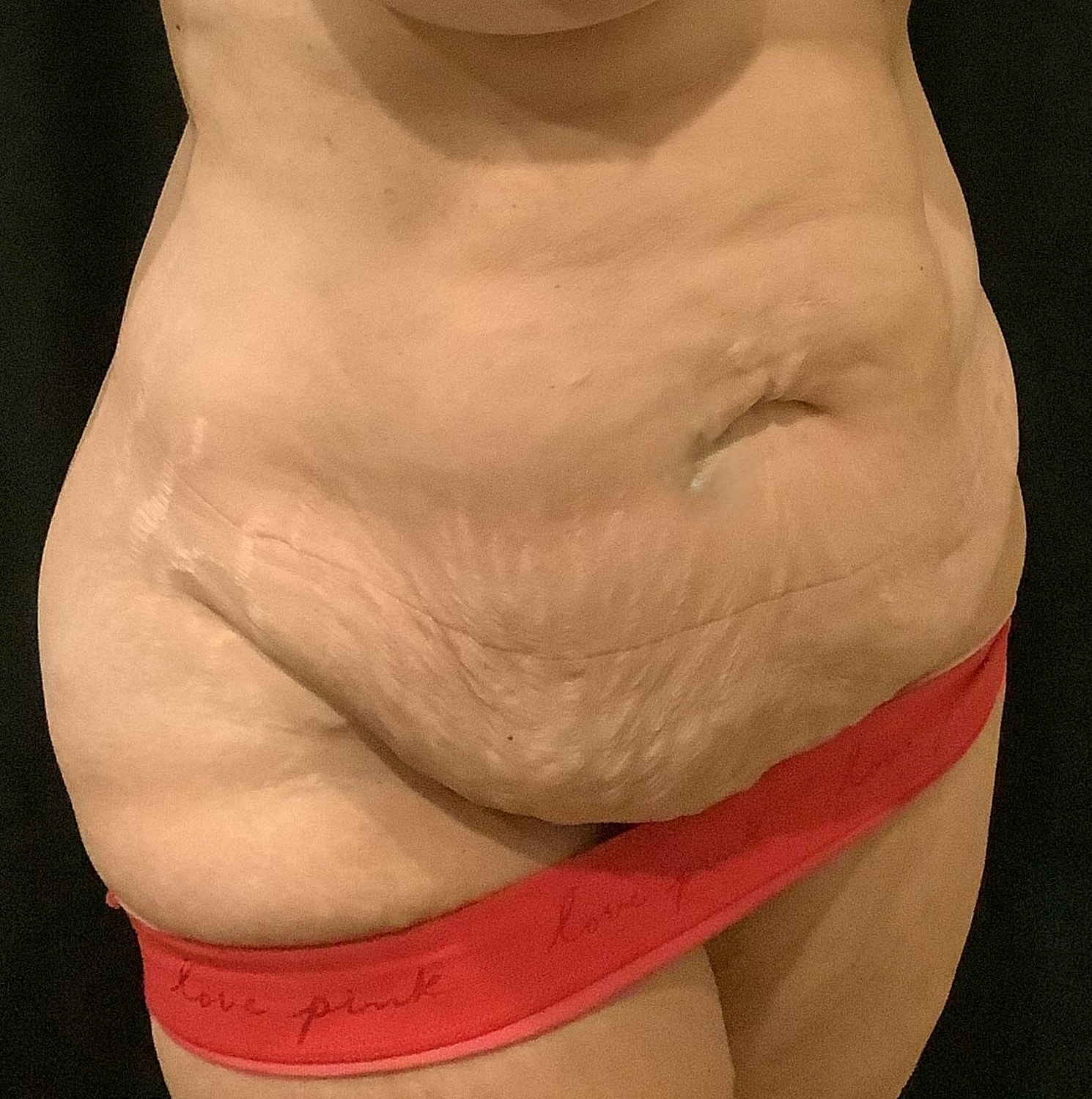 Tummy Tuck Before & After