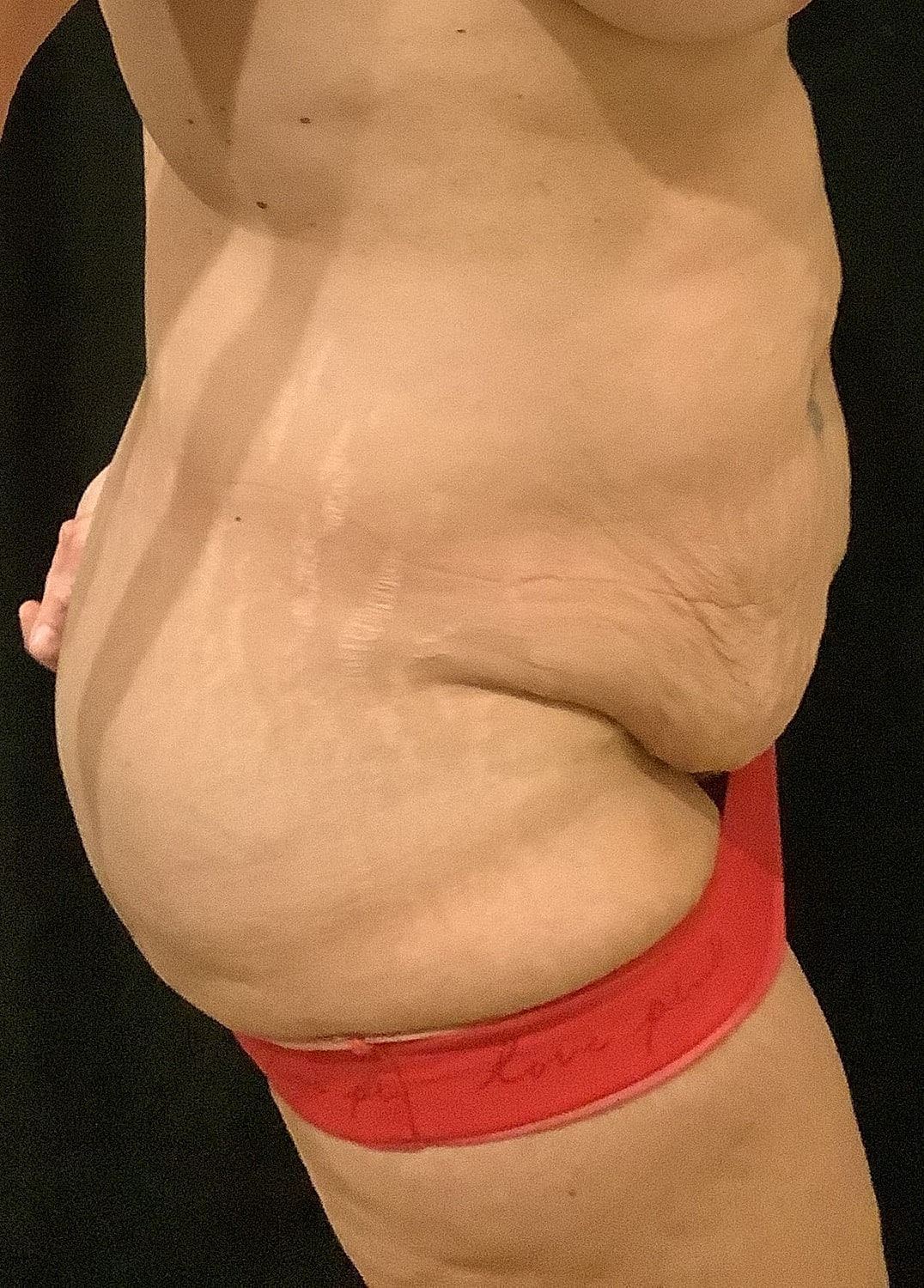 Tummy Tuck Before & After