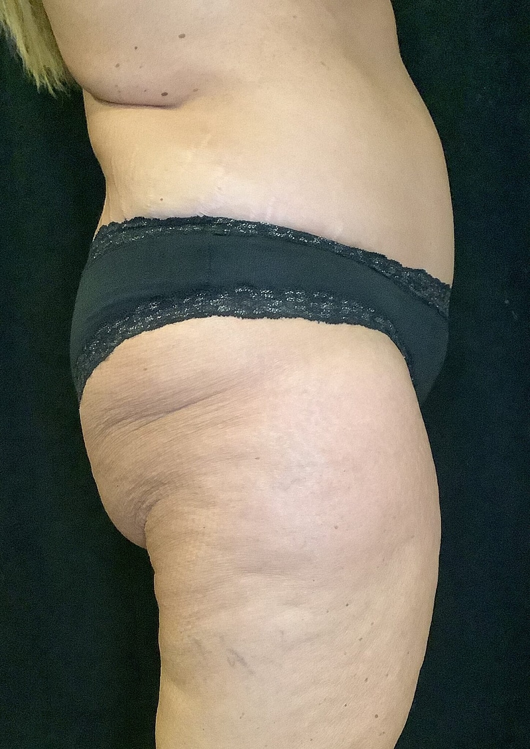 Tummy Tuck Before & After