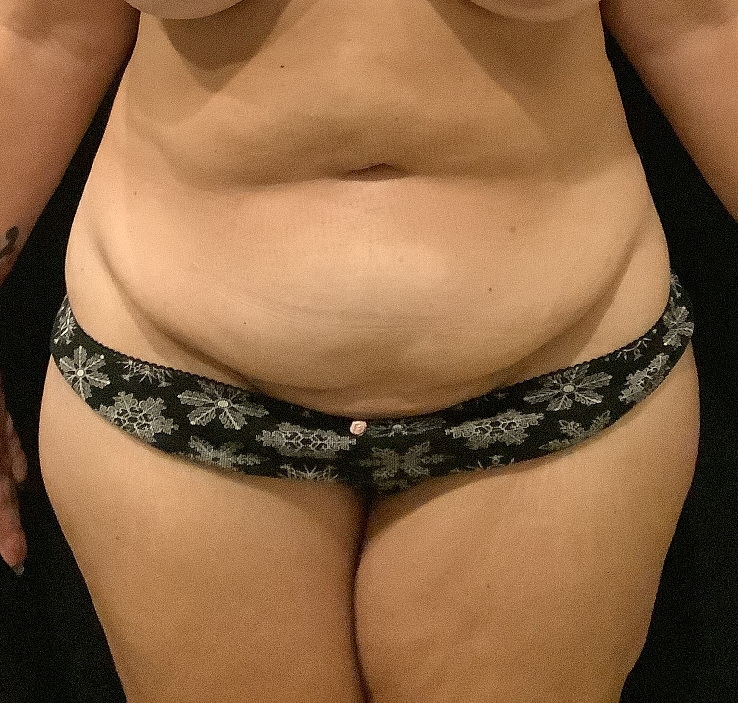 Tummy Tuck Before & After