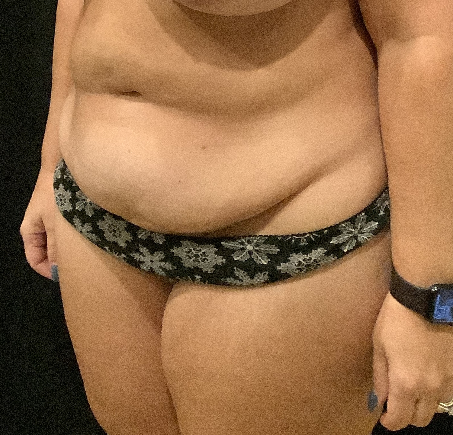 Tummy Tuck Before & After