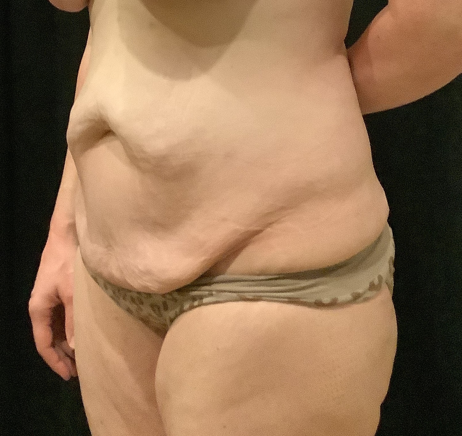 Tummy Tuck Before & After