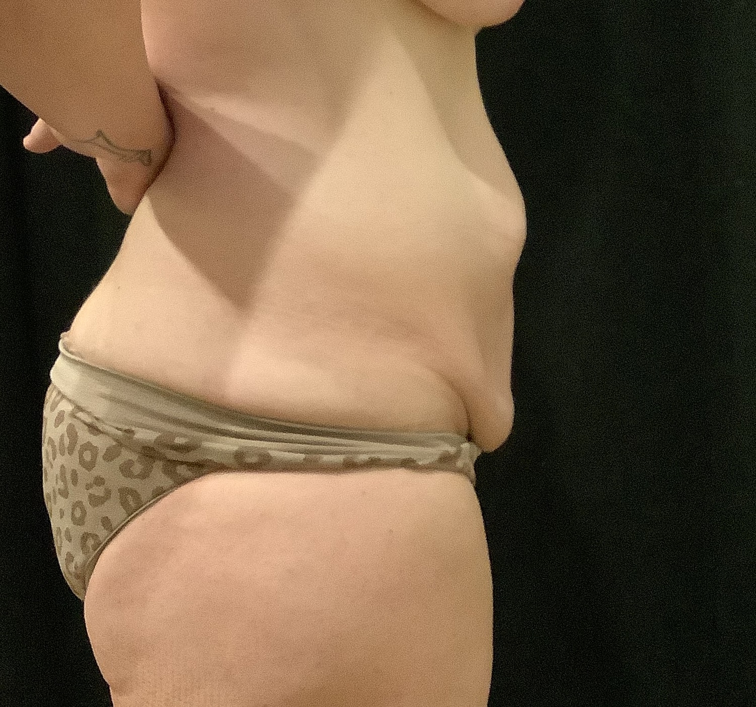Tummy Tuck Before & After