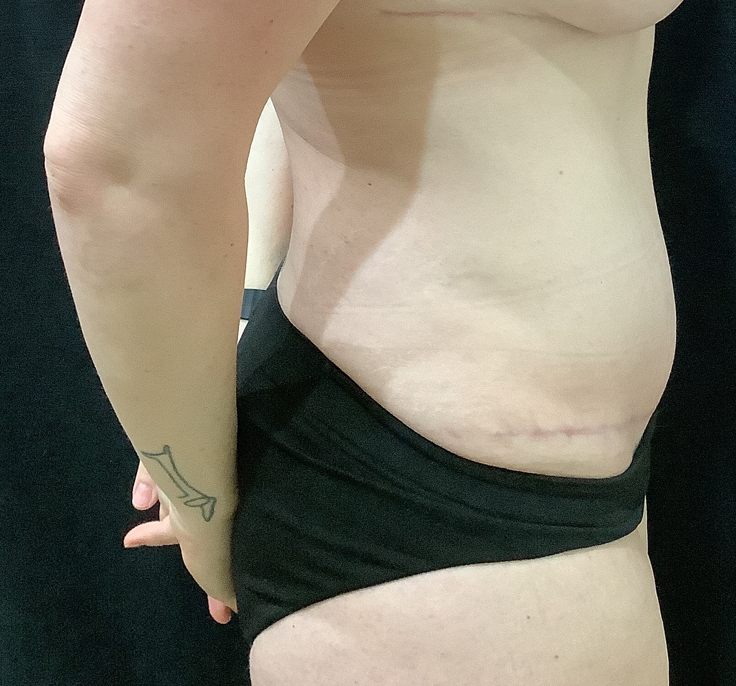 Tummy Tuck Before & After