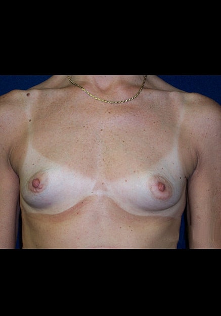 Breast Augmentation Before & After