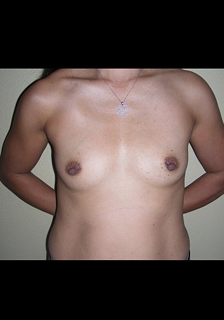 Breast Augmentation Before & After