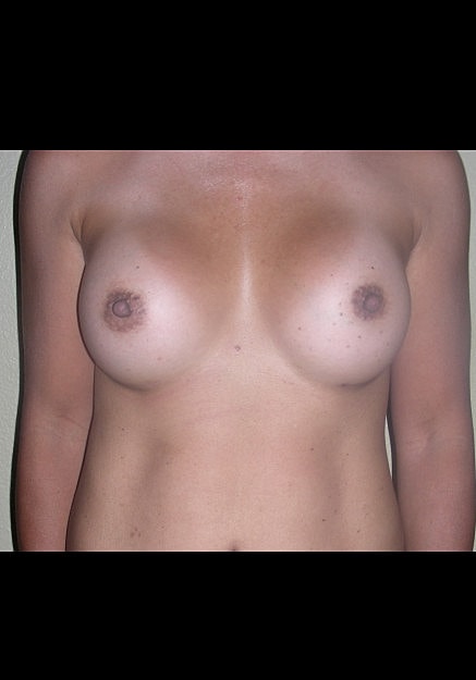 Breast Augmentation Before & After