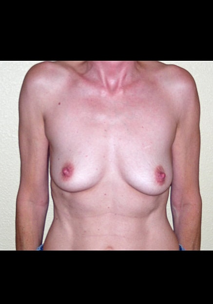 Breast Augmentation Before & After