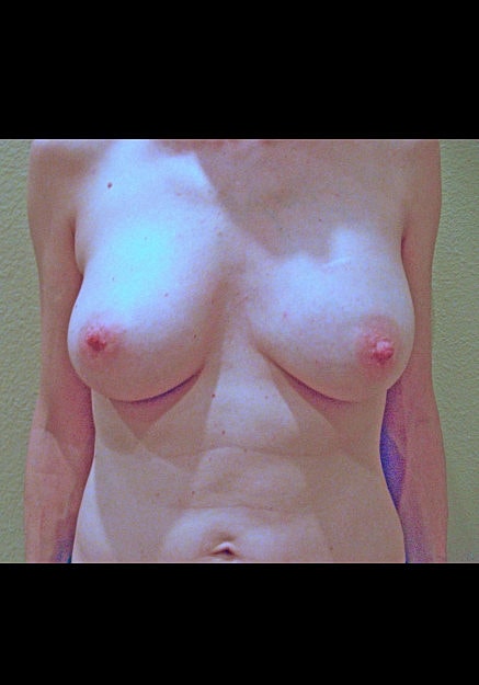 Breast Augmentation Before & After