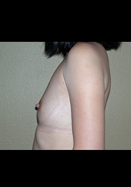 Breast Augmentation Before & After