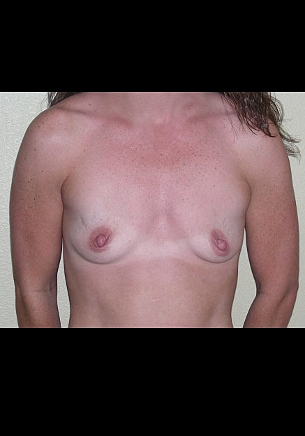 Breast Augmentation Before & After