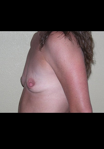 Breast Augmentation Before & After