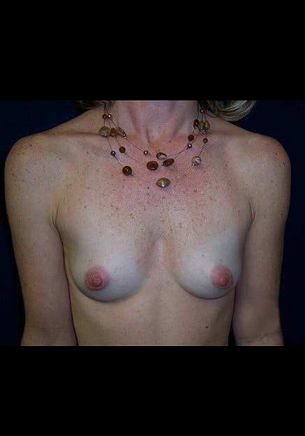 Breast Augmentation Before & After