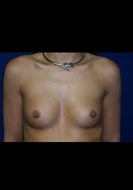 Breast Augmentation Before & After