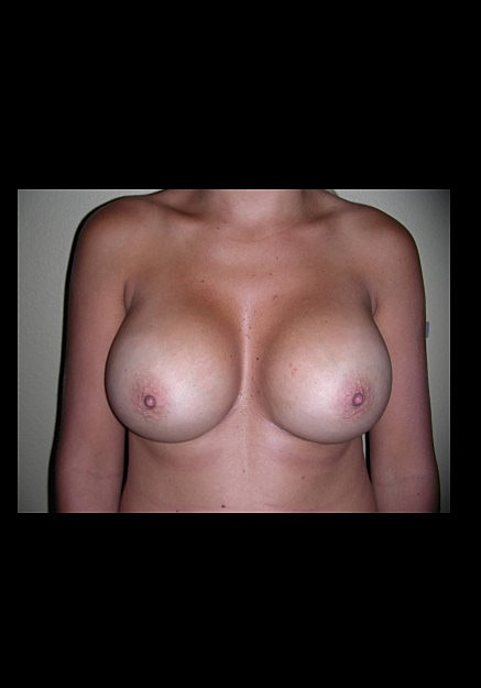 Breast Augmentation Before & After