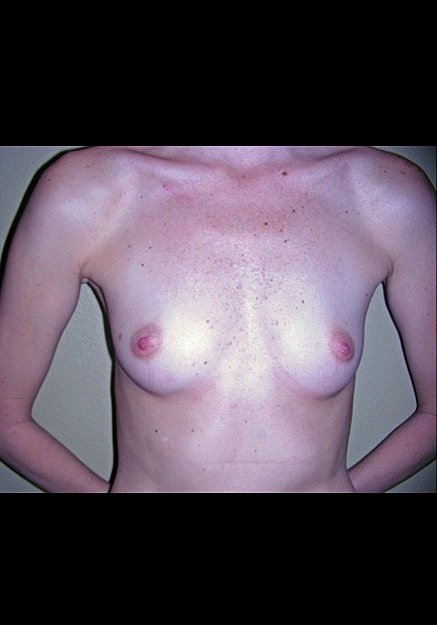 Breast Augmentation Before & After