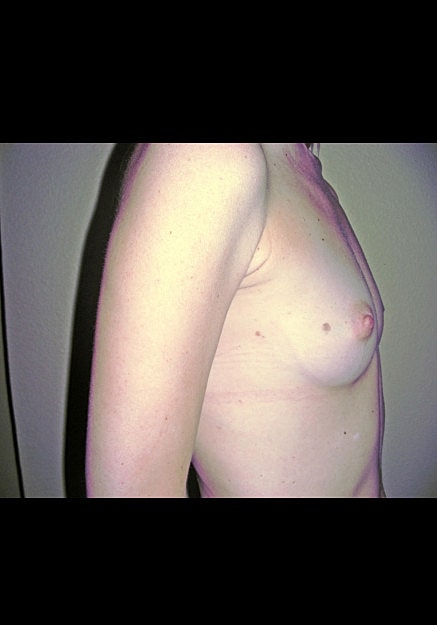 Breast Augmentation Before & After