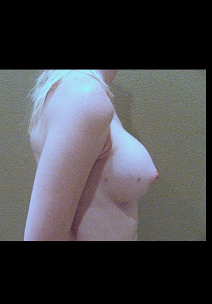Breast Augmentation Before & After