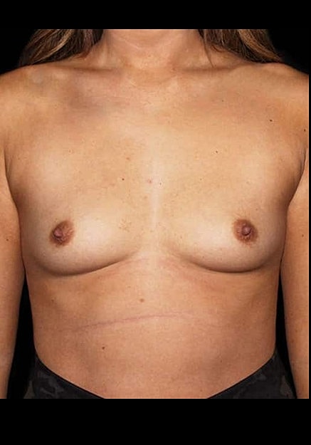Breast Augmentation Before & After