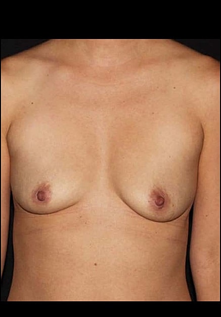 Breast Augmentation Before & After