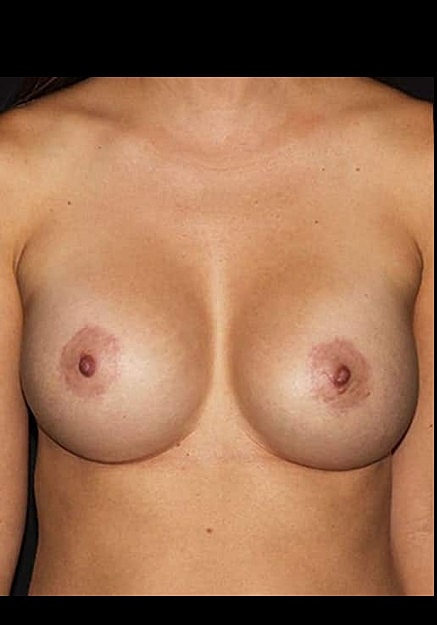 Breast Augmentation Before & After