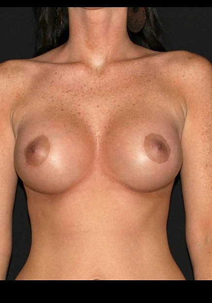 Breast Augmentation Before & After