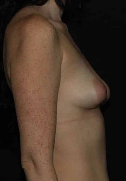 Breast Augmentation Before & After