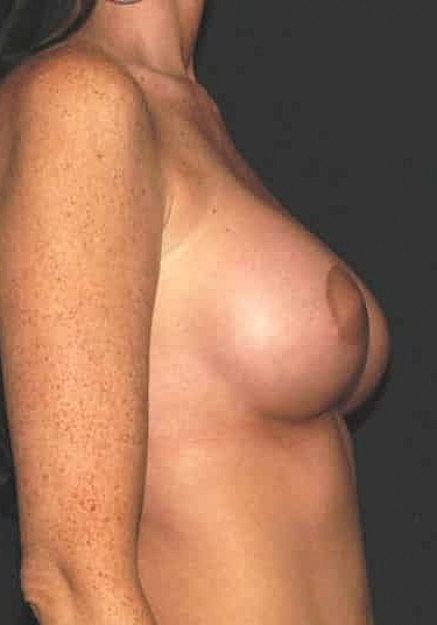 Breast Augmentation Before & After