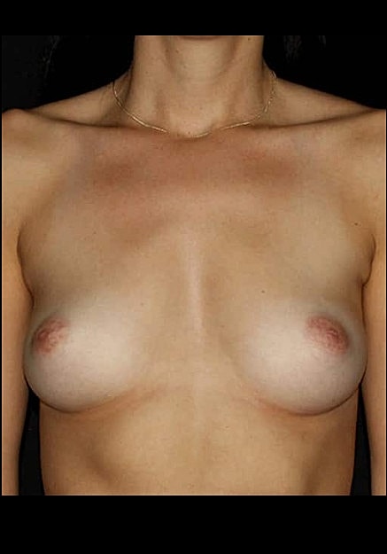 Breast Augmentation Before & After