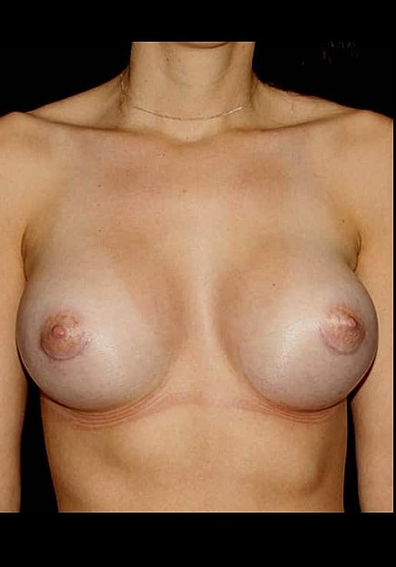Breast Augmentation Before & After