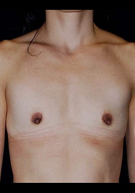 Breast Augmentation Before & After