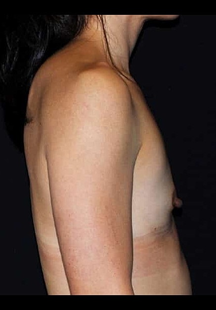 Breast Augmentation Before & After