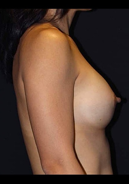 Breast Augmentation Before & After
