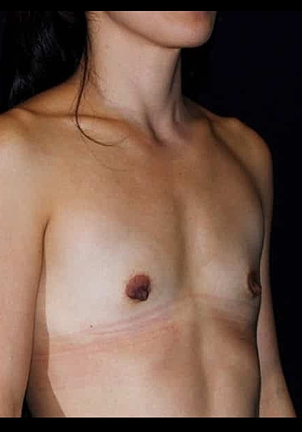 Breast Augmentation Before & After