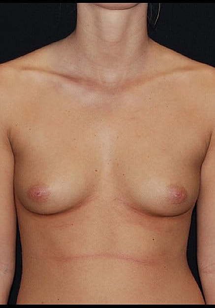 Breast Augmentation Before & After