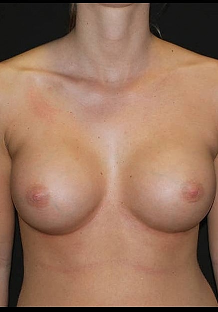 Breast Augmentation Before & After