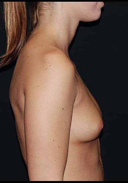 Breast Augmentation Before & After